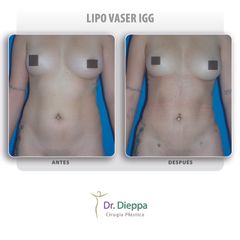 Lipo Vaser IGG  - Cirugía Plástica Dieppa