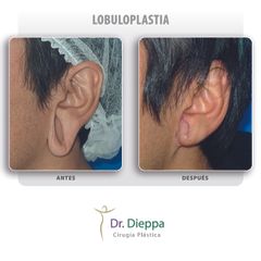 Lobuloplastia  - Cirugía Plástica Dieppa