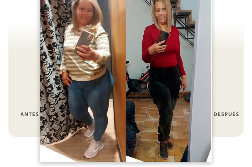 Balón intragástrico antes y después - 852690