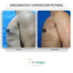 Ginecomastia - Cirugía Plástica Dieppa