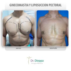Ginecomastia - Cirugía Plástica Dieppa