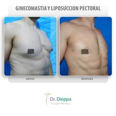 Ginecomastia - Cirugía Plástica Dieppa