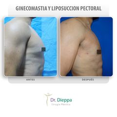 Ginecomastia - Cirugía Plástica Dieppa