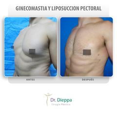 Ginecomastia - Cirugía Plástica Dieppa