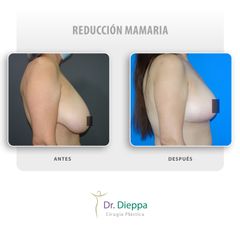 Reducción mamaria - Cirugía Plástica Dieppa