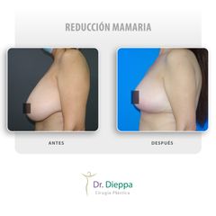 Reducción mamaria - Cirugía Plástica Dieppa
