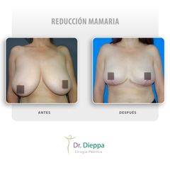 Reducción mamaria - Cirugía Plástica Dieppa