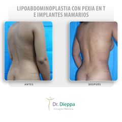 Lipoabdominoplastia con pexia en T e implantes mamarios - Cirugía Plástica Dieppa
