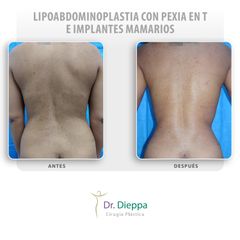 Lipoabdominoplastia con pexia en T e implantes mamarios - Cirugía Plástica Dieppa