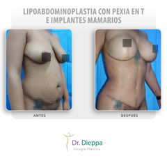 Lipoabdominoplastia con pexia en T e implantes mamarios - Cirugía Plástica Dieppa