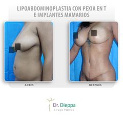 Lipoabdominoplastia con pexia en T e implantes mamarios - Cirugía Plástica Dieppa