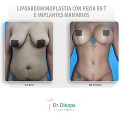 Lipoabdominoplastia con pexia en T e implantes mamarios - Cirugía Plástica Dieppa