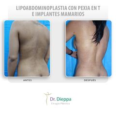 Lipoabdominoplastia con pexia en T e implantes mamarios - Cirugía Plástica Dieppa