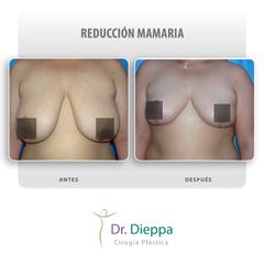 Reducción mamaria - Cirugía Plástica Dieppa