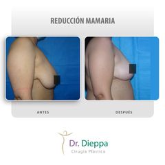 Reducción mamaria - Cirugía Plástica Dieppa