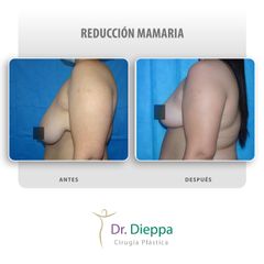 Reducción mamaria - Cirugía Plástica Dieppa