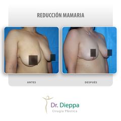 Reducción mamaria - Cirugía Plástica Dieppa