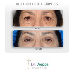 Blefaroplastia - Cirugía Plástica Dieppa