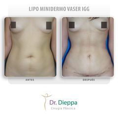 Lipoescultura - Cirugía Plástica Dieppa
