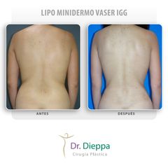 Lipoescultura - Cirugía Plástica Dieppa