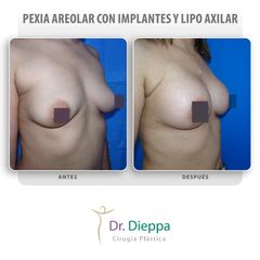 Mastopexia - Cirugía Plástica Dieppa