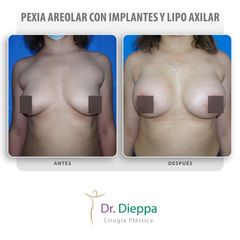 Mastopexia - Cirugía Plástica Dieppa