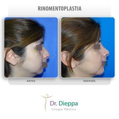 Rinomentoplastia - Cirugía Plástica Dieppa