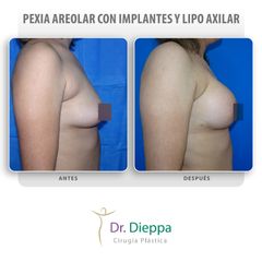 Aumento mamario - Cirugía Plástica Dieppa