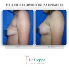 Aumento mamario - Cirugía Plástica Dieppa