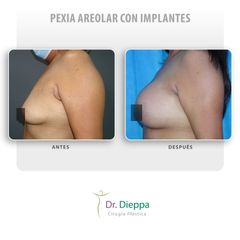 Pexia areolar con implantes