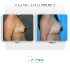 Pexia areolar con implantes