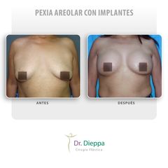 Pexia areolar con implantes