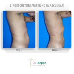 Lipoescultura Vaser HD (masculina)