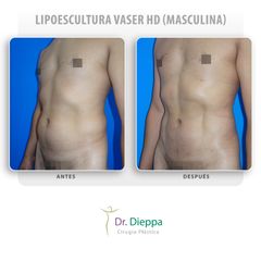 Lipoescultura Vaser HD (masculina)