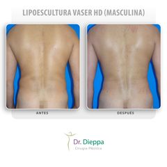Lipoescultura Vaser HD (masculina)