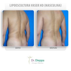 Lipoescultura Vaser HD (masculina)