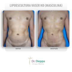 Lipoescultura Vaser HD (masculina)