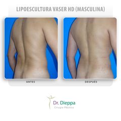 Lipoescultura Vaser HD (masculina)