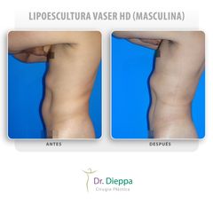 Lipoescultura Vaser HD (masculina)