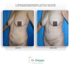 Lipoabdominoplastia vaser