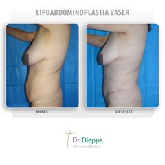 Lipoabdominoplastia vaser