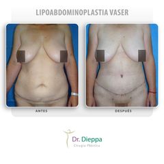 Lipoabdominoplastia vaser