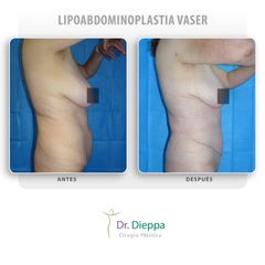 Lipoabdominoplastia vaser
