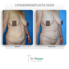 Lipoabdominoplastia vaser