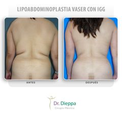Lipoabdominoplastia vaser con IGG