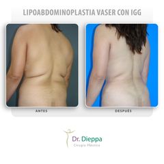 Lipoabdominoplastia vaser con IGG
