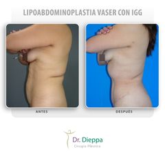 Lipoabdominoplastia vaser con IGG