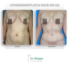Lipoabdominoplastia vaser con IGG