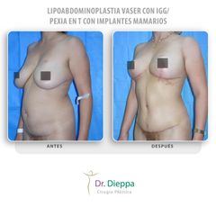 Lipoabdominoplastia Vaser - Cirugía Plástica Dieppa