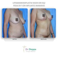 Lipoabdominoplastia Vaser - Cirugía Plástica Dieppa